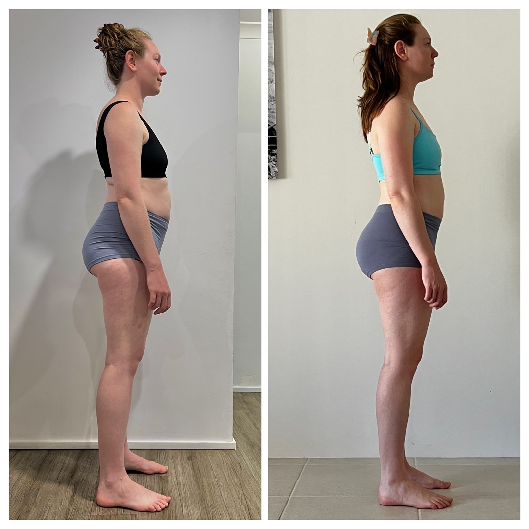 Before and after posture comparison — side view showing structural changes after treatment