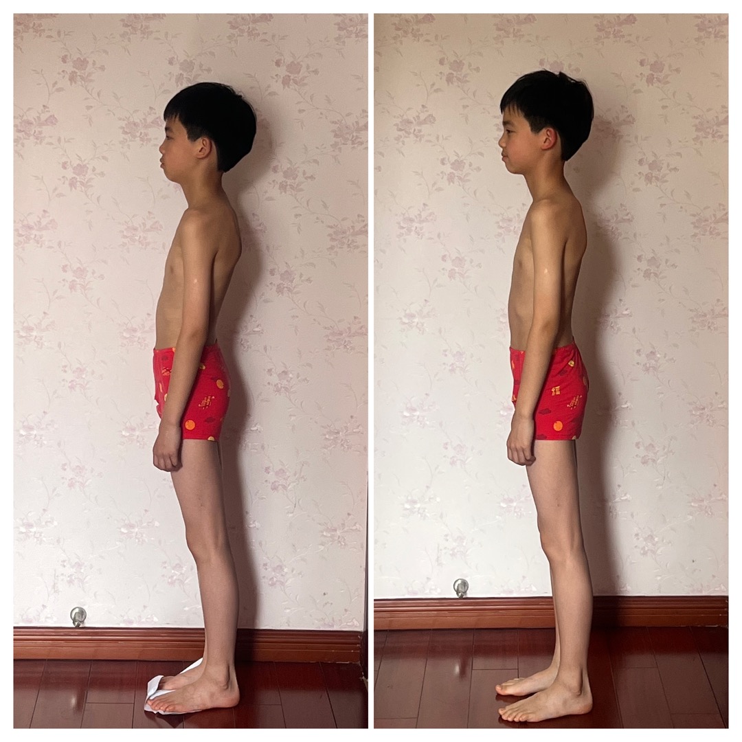 Before and after posture comparison — side view showing structural changes in an adolescent after Structural Bodywork treatment
