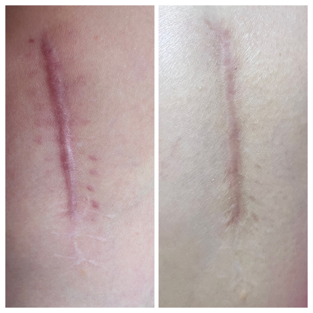 Before and after comparison of scar tissue showing improvement after ongoing ScarWork treatment